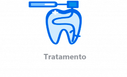 Etapas da Endodontia -Tratamento